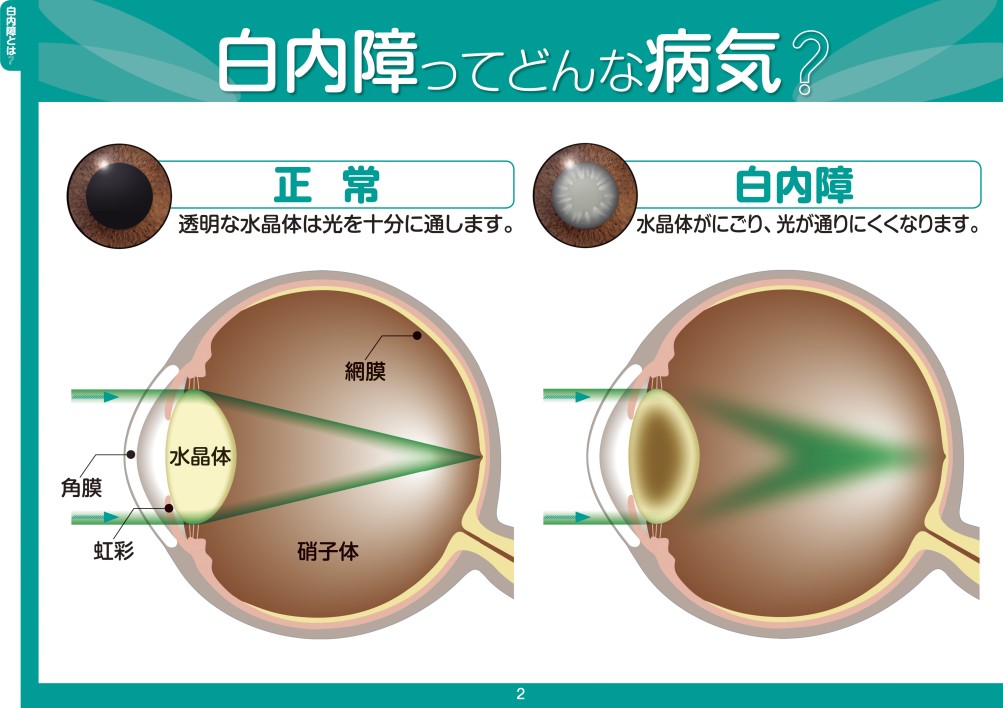 白内障の見え方