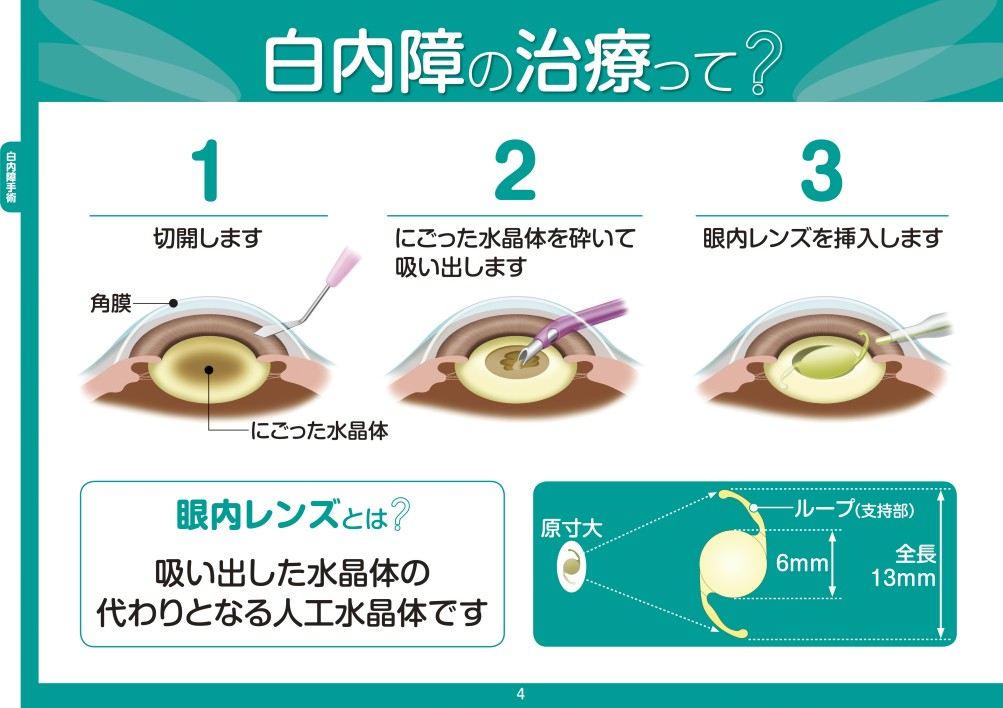 白内障の治療